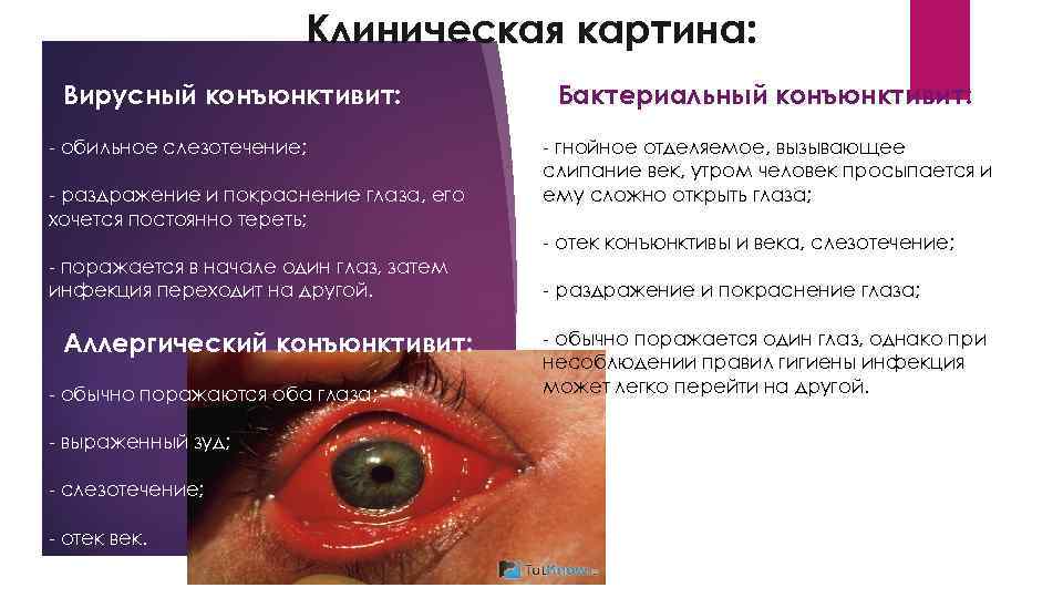 Клиническая картина: Вирусный конъюнктивит: - обильное слезотечение; - раздражение и покраснение глаза, его хочется