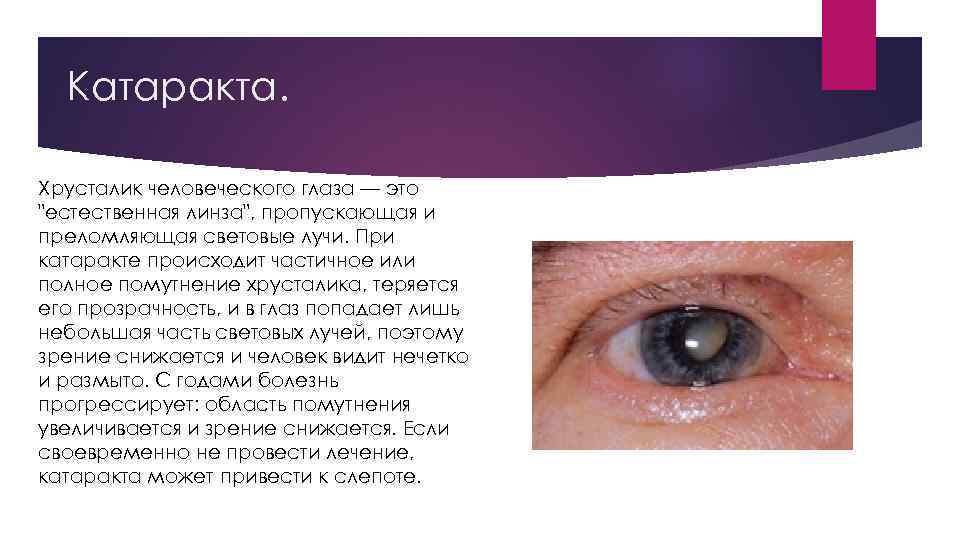 Катаракта. Хрусталик человеческого глаза — это "естественная линза", пропускающая и преломляющая световые лучи. При