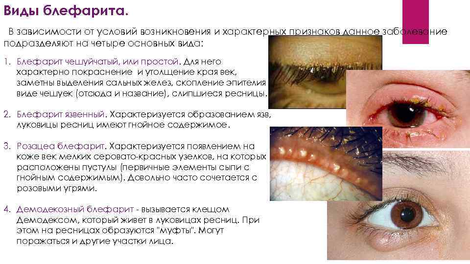 Виды блефарита. В зависимости от условий возникновения и характерных признаков данное заболевание подразделяют на