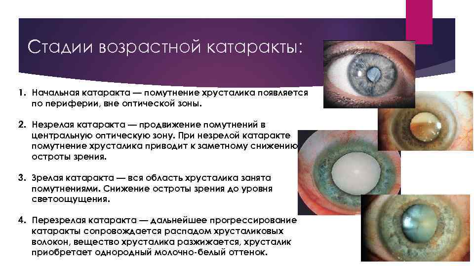 Причины развития катаракты