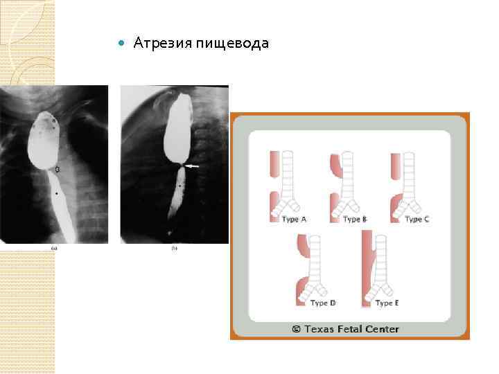  Атрезия пищевода 