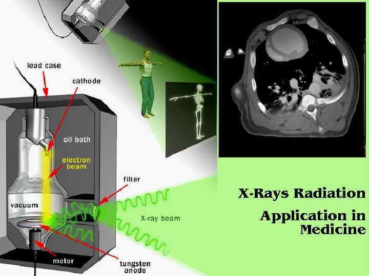 X-Rays Radiation Application in Medicine 