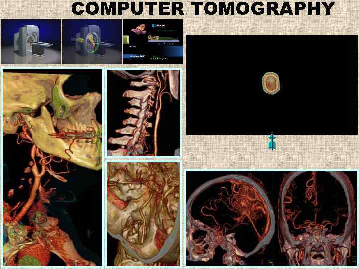 COMPUTER TOMOGRAPHY 