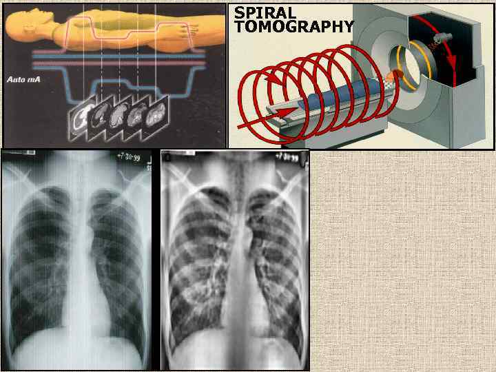 SPIRAL TOMOGRAPHY 