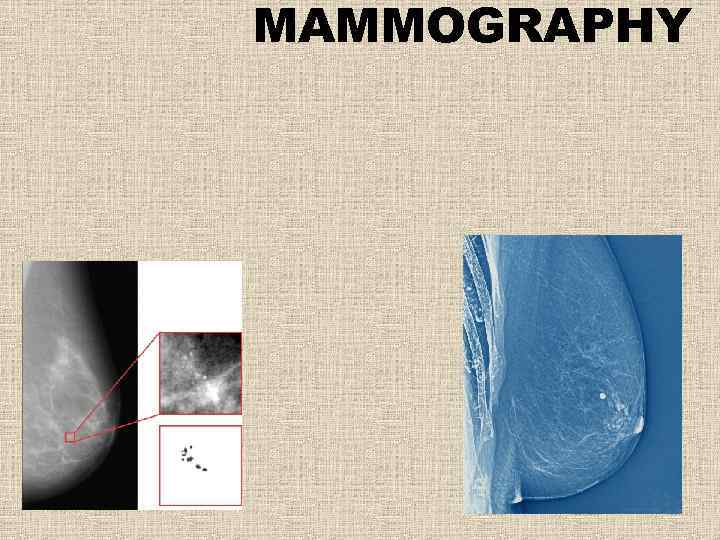MAMMOGRAPHY 