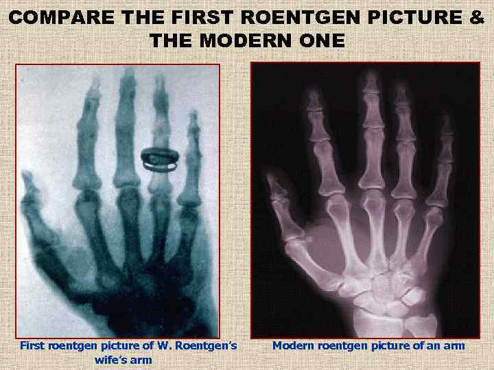 COMPARE THE FIRST ROENTGEN PICTURE & THE MODERN ONE First roentgen picture of W.