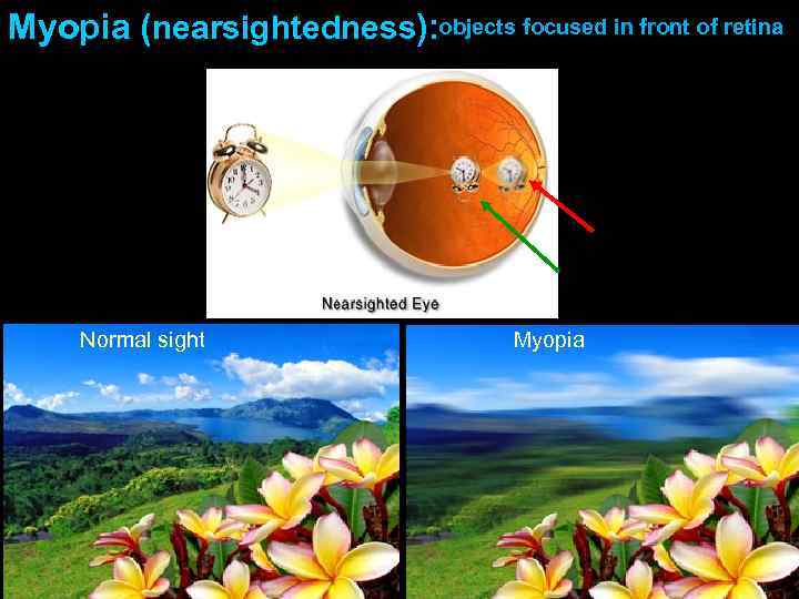 Myopia (nearsightedness): objects focused in front of retina Normal sight Myopia 