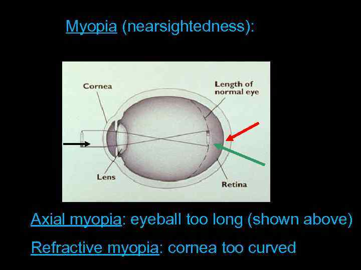 Length of Eyeball + Curvature of Myopia (nearsightedness): Cornea Axial myopia: eyeball too long