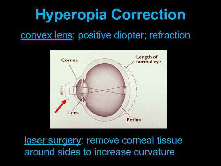 Hyperopia Correction convex lens: positive diopter; refraction laser surgery: remove corneal tissue around sides