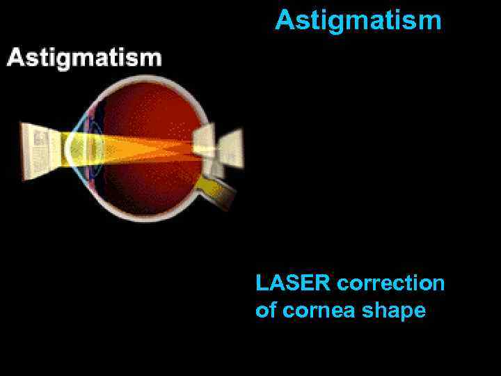 Astigmatism LASER correction of cornea shape 