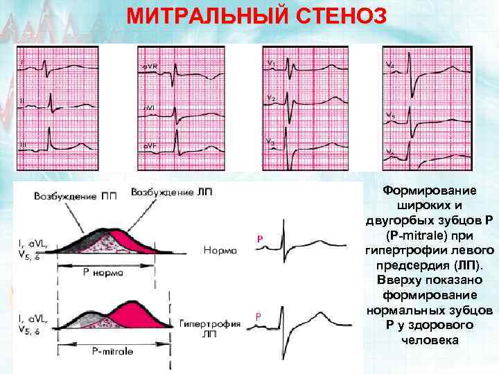 МИТРАЛЬНЫЙ СТЕНОЗ Формирование широких и двугорбых зубцов Р (P-mitrale) при гипертрофии левого предсердия (ЛП).