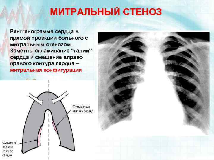 МИТРАЛЬНЫЙ СТЕНОЗ Рентгенограмма сердца в прямой проекции больного с митральным стенозом. Заметны сглаживание "талии"