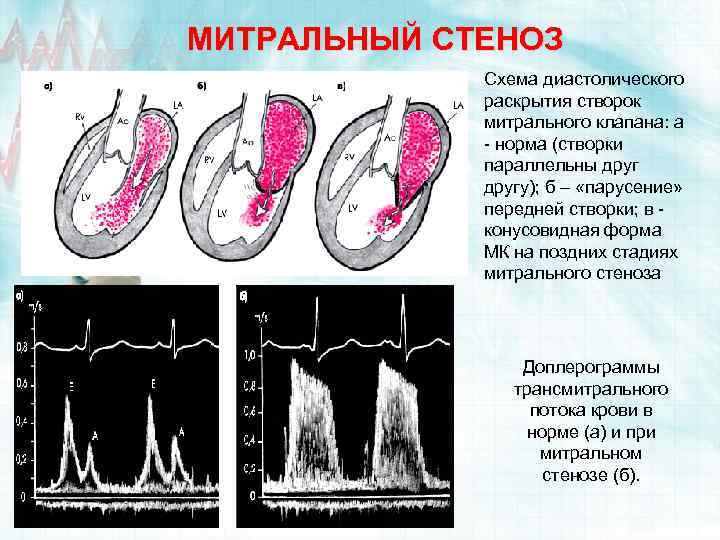 МИТРАЛЬНЫЙ СТЕНОЗ Схема диастолического раскрытия створок митрального клапана: а - норма (створки параллельны другу);