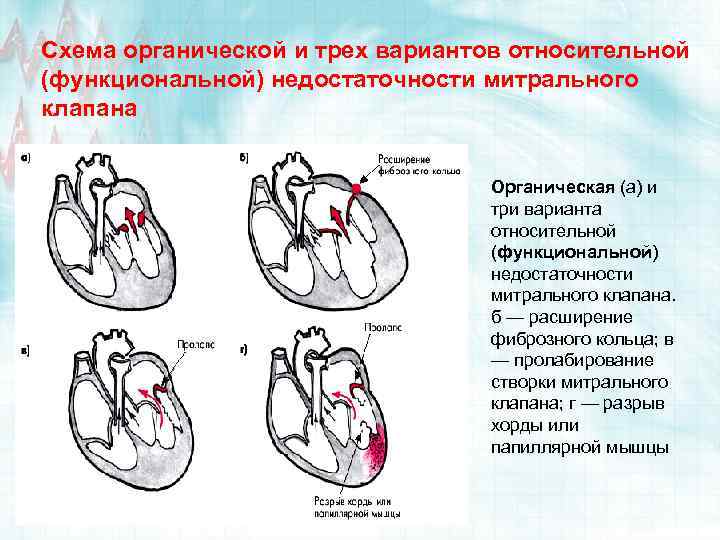 Схема органической и трех вариантов относительной (функциональной) недостаточности митрального клапана Органическая (а) и три