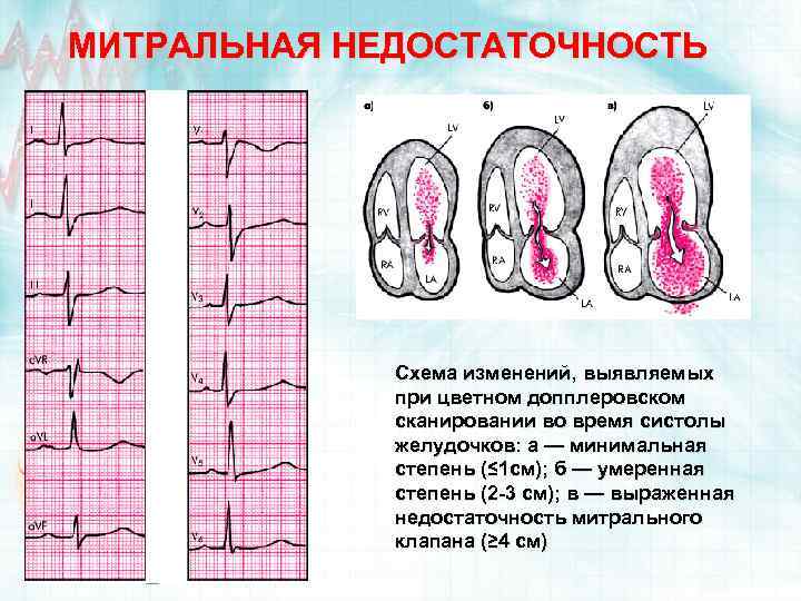 МИТРАЛЬНАЯ НЕДОСТАТОЧНОСТЬ Схема изменений, выявляемых при цветном допплеровском сканировании во время систолы желудочков: а