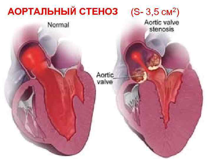 АОРТАЛЬНЫЙ СТЕНОЗ (S- 3, 5 см 2) 