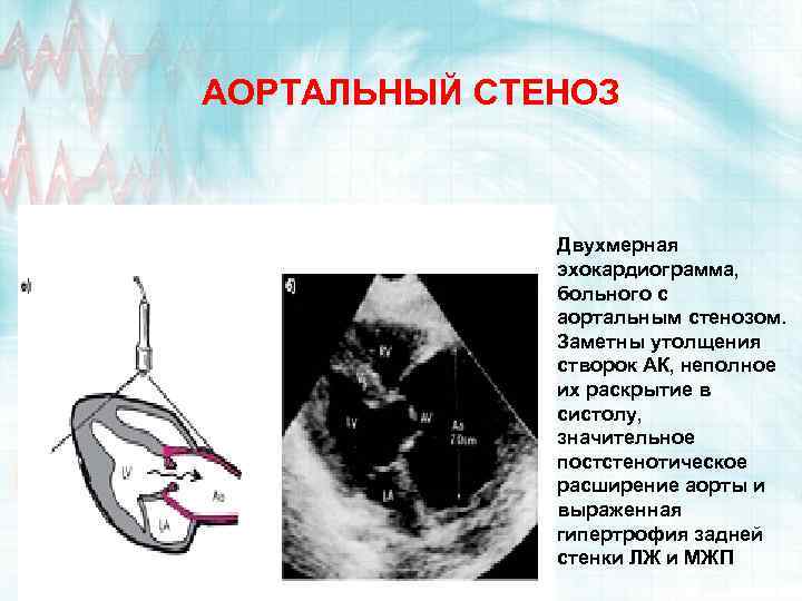 АОРТАЛЬНЫЙ СТЕНОЗ Двухмерная эхокардиограмма, больного с аортальным стенозом. Заметны утолщения створок АК, неполное их