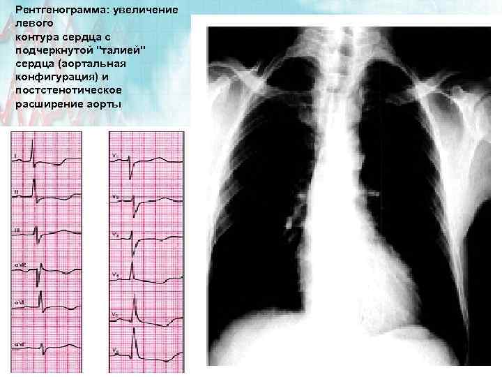 Рентгенограмма: увеличение левого контура сердца с подчеркнутой "талией" сердца (аортальная конфигурация) и постстенотическое расширение