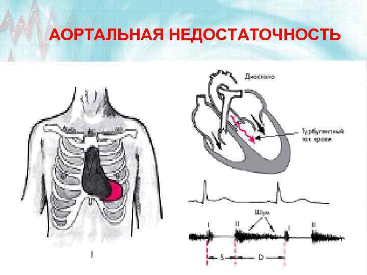 АОРТАЛЬНАЯ НЕДОСТАТОЧНОСТЬ 