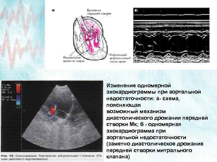 Изменение одномерной эхокардиограммы при аортальной недостаточности: а- схема, поясняющая возможный механизм диастолического дрожания передней