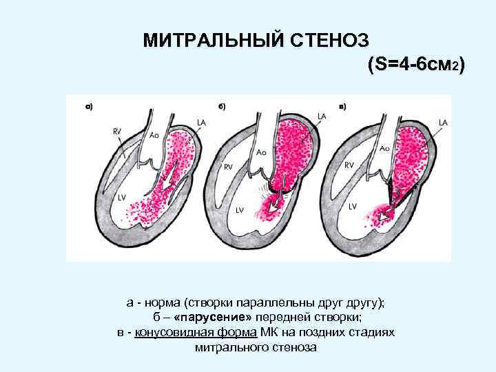 МИТРАЛЬНЫЙ СТЕНОЗ ( S=4 -6 см 2) а - норма (створки параллельны другу); б