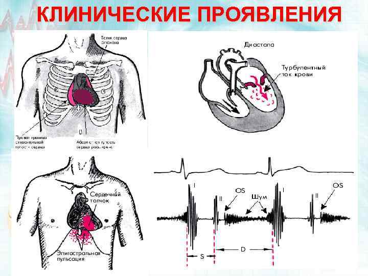 КЛИНИЧЕСКИЕ ПРОЯВЛЕНИЯ 