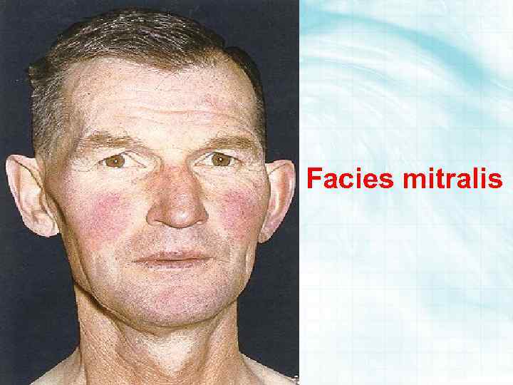 Facies mitralis 