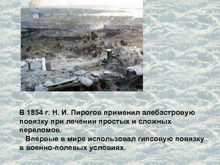 В 1854 г. Н. И. Пирогов применил алебастровую повязку при лечении простых и сложных