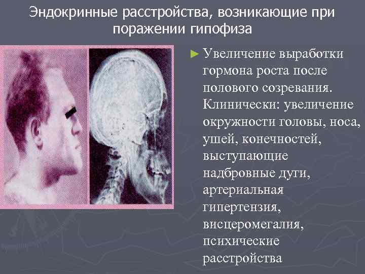 Эндокринные расстройства, возникающие при поражении гипофиза ► Увеличение выработки гормона роста после полового созревания.