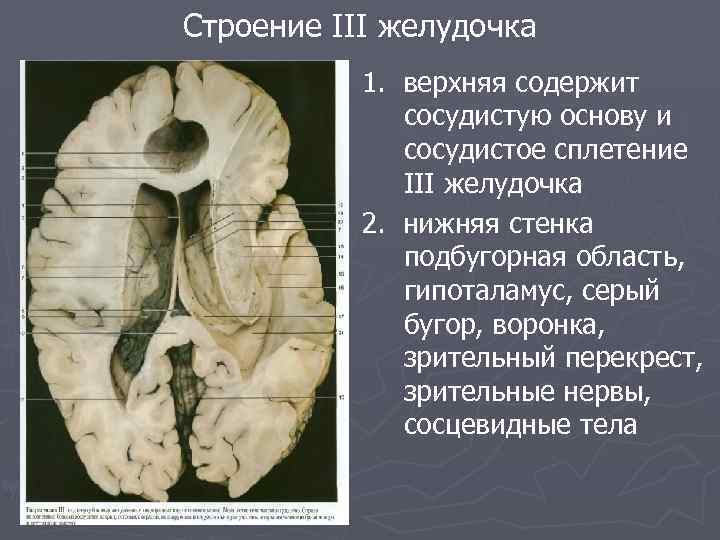 3 желудочек. Эпифиз полость 3 желудочка. Нижняя стенка третьего желудочка. Третий желудочек анатомия. Верхняя стенка 3 желудочка мозга.