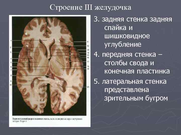 Строение III желудочка 3. задняя стенка задняя спайка и шишковидное углубление 4. передняя стенка