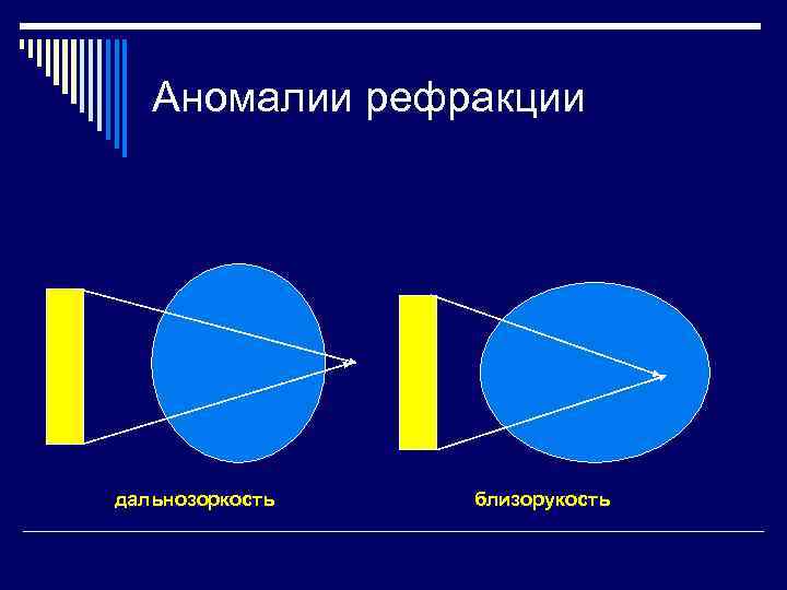 Аномалии рефракции дальнозоркость близорукость 