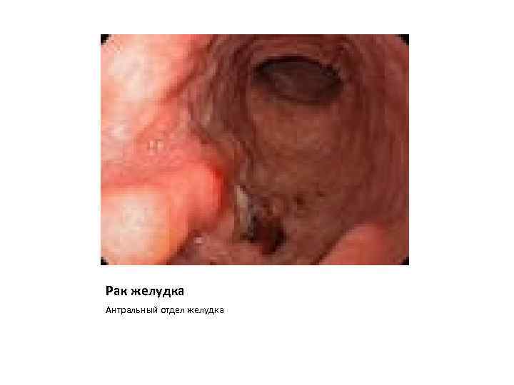 Рак желудка Антральный отдел желудка 