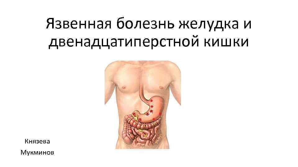 Язвенная болезнь желудка и двенадцатиперстной кишки Князева Мукминов 