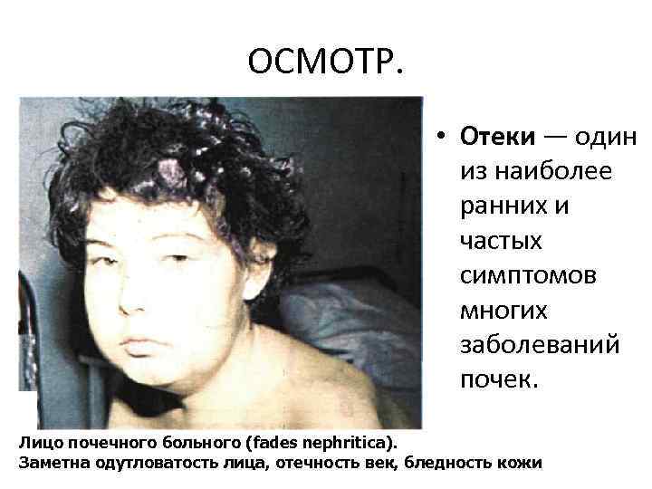 ОСМОТР. • Отеки — один из наиболее ранних и частых симптомов многих заболеваний почек.
