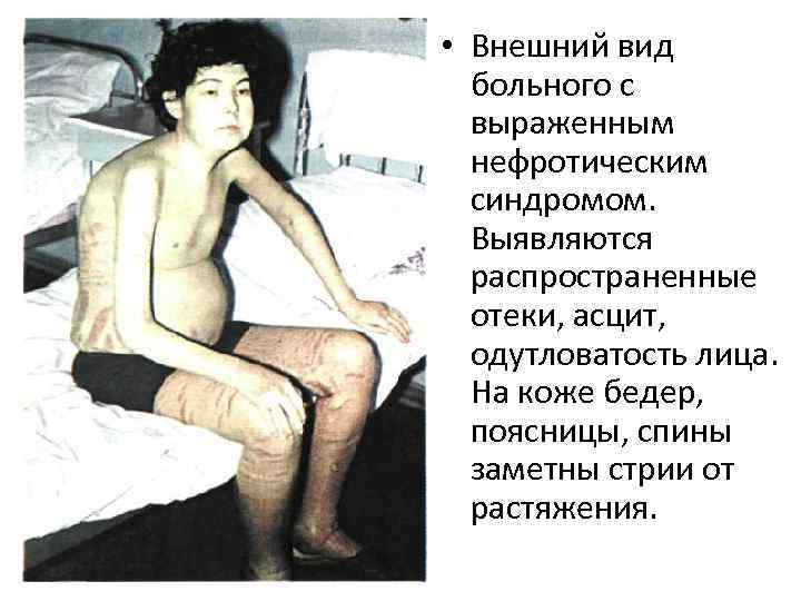  • Внешний вид больного с выраженным нефротическим синдромом. Выявляются распространенные отеки, асцит, одутловатость