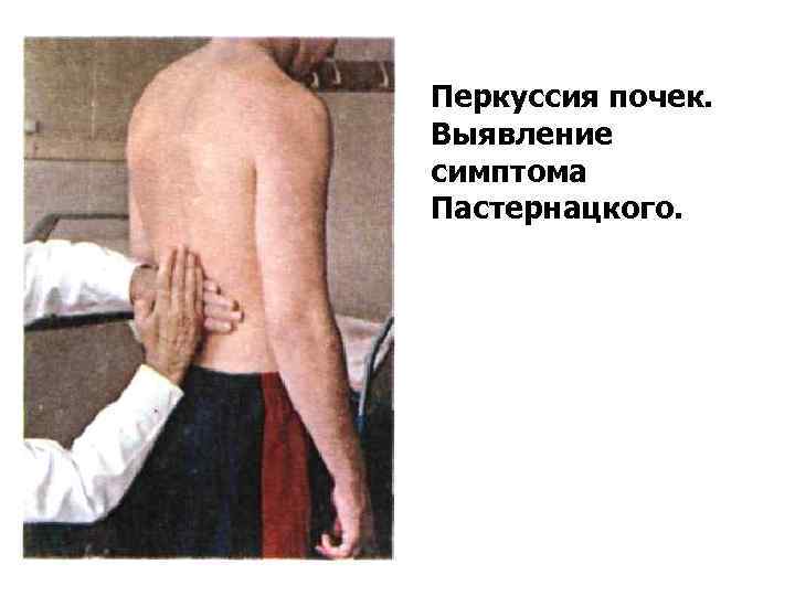 Перкуссия почек. Выявление симптома Пастернацкого. 