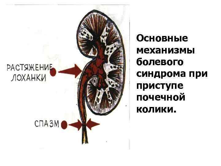 Основные механизмы болевого синдрома приступе почечной колики. 