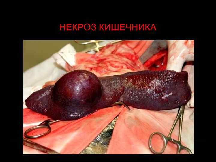 НЕКРОЗ КИШЕЧНИКА 