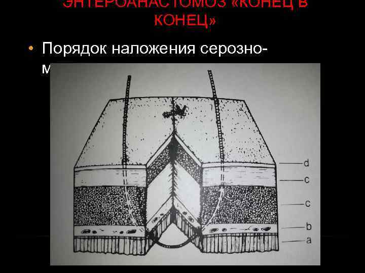 ЭНТЕРОАНАСТОМОЗ «КОНЕЦ В КОНЕЦ» • Порядок наложения серозномышечного шва 