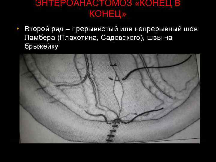 ЭНТЕРОАНАСТОМОЗ «КОНЕЦ В КОНЕЦ» • Второй ряд – прерывистый или непрерывный шов Ламбера (Плахотина,