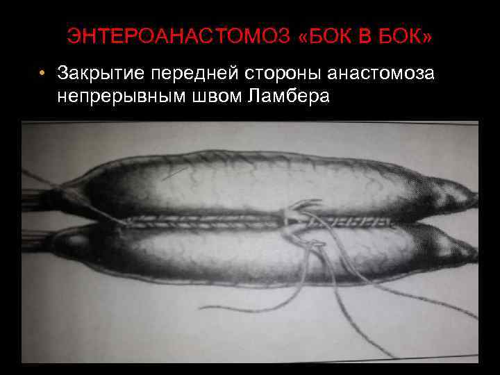 ЭНТЕРОАНАСТОМОЗ «БОК В БОК» • Закрытие передней стороны анастомоза непрерывным швом Ламбера 