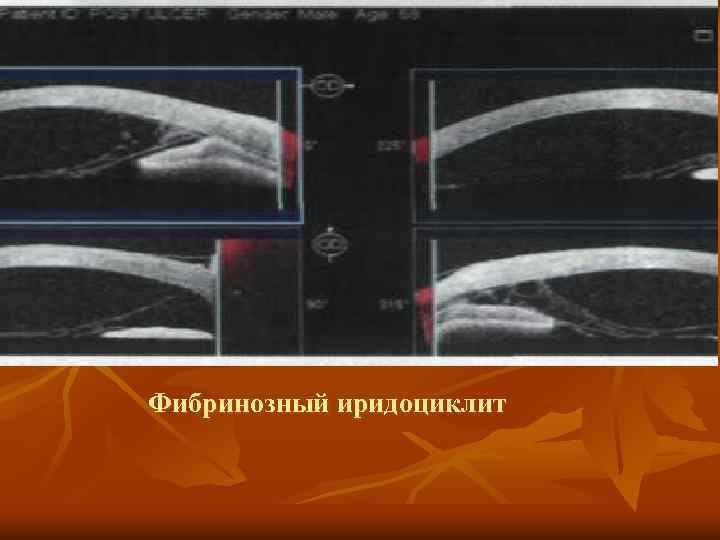 Фибринозный иридоциклит 