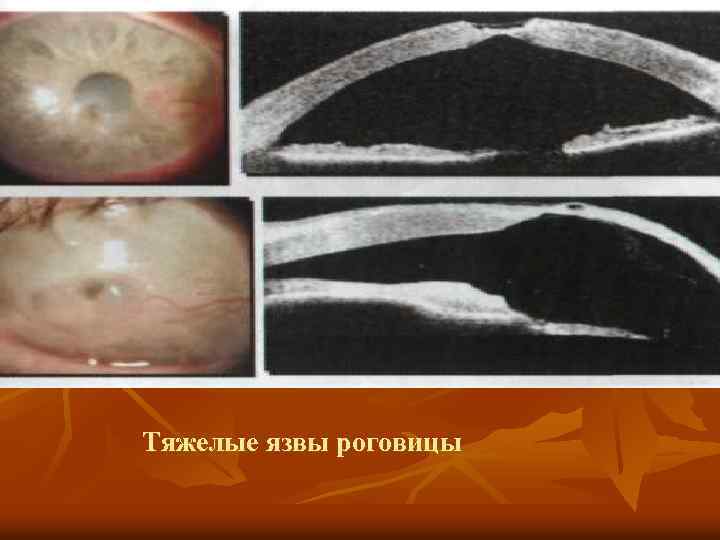 Тяжелые язвы роговицы 