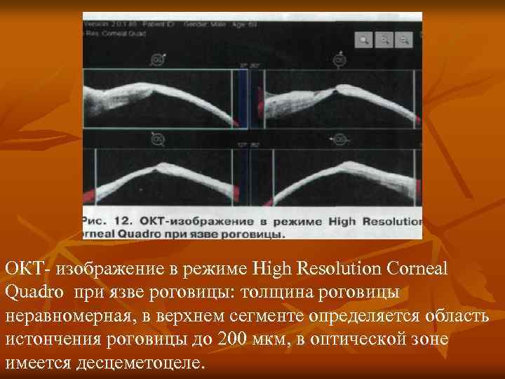 ОКТ- изображение в режиме High Resolution Corneal Quadro при язве роговицы: толщина роговицы неравномерная,