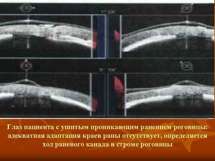 Глаз пациента с ушитым проникающим ранением роговицы: адекватная адаптация краев раны отсутствует, определяется ход