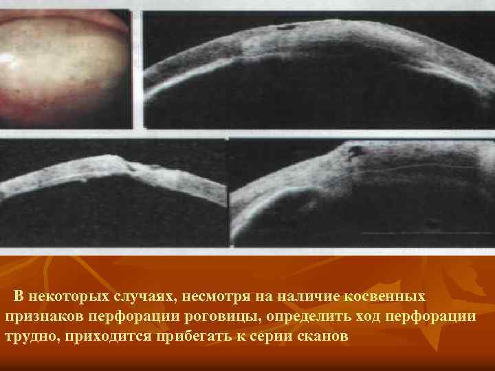 В некоторых случаях, несмотря на наличие косвенных признаков перфорации роговицы, определить ход перфорации трудно,