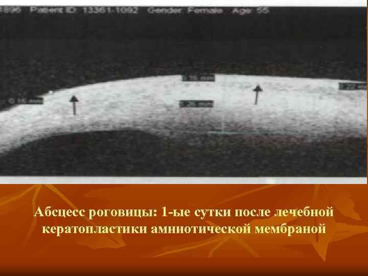 Абсцесс роговицы: 1 -ые сутки после лечебной кератопластики амниотической мембраной 