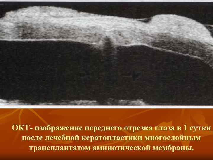 ОКТ- изображение переднего отрезка глаза в 1 сутки после лечебной кератопластики многослойным трансплантатом амниотической