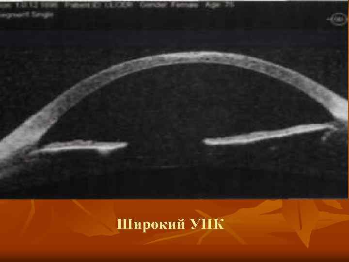 Широкий УПК 